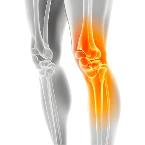 image of a knee with arthritis