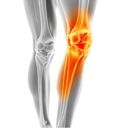 image of a knee joint with arthritis